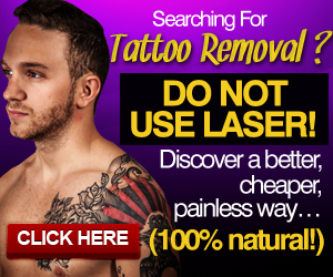 Tattoo Removal